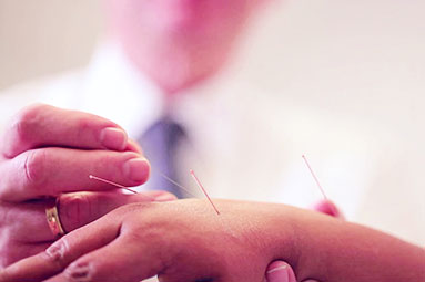medycyna integracyjna, akupunktura
