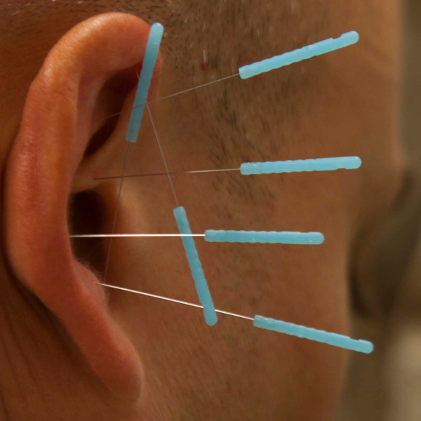 Aurikuloterapia, akupunktura ucha, ucho nakłute igłami